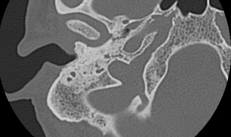 File:Bilateral cholesteatoma (Radiopaedia 54898-61172 Axial bone window 4).jpg