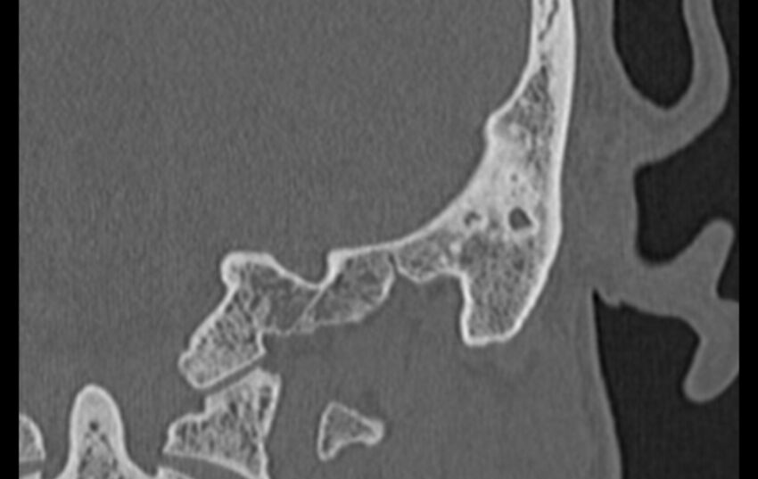 Bilateral cholesteatoma (Radiopaedia 54898-61172 D 59).jpg