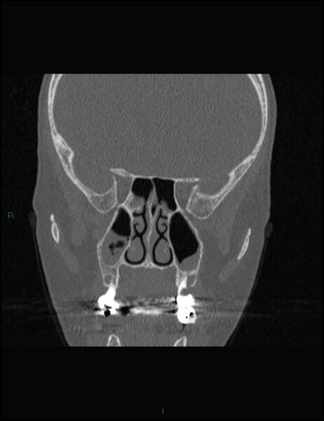 File:Bilateral frontal mucoceles (Radiopaedia 82352-96454 Coronal 180).jpg