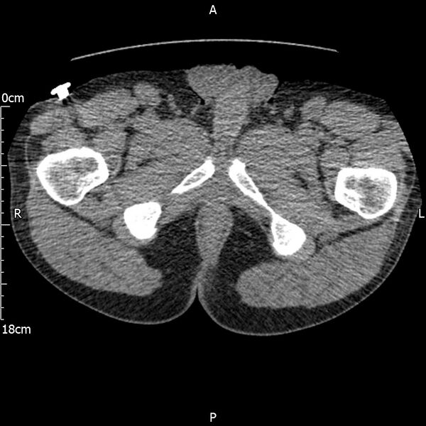 File:Bilateral medullary nephrocalcinosis with ureteric calculi (Radiopaedia 71269-81569 Axial non-contrast 144).jpg