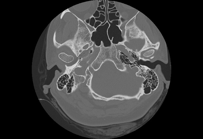 File:Bilateral otospongiosis (Radiopaedia 35447-36940 Axial bone window 12).jpg