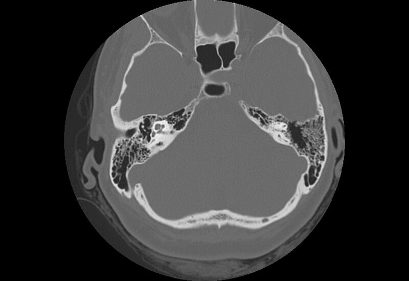 File:Bilateral otospongiosis (Radiopaedia 35447-36940 Axial bone window 32).jpg