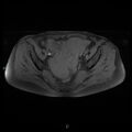 Bilateral ovarian fibroma (Radiopaedia 44568-48293 Axial T1 fat sat 13).jpg