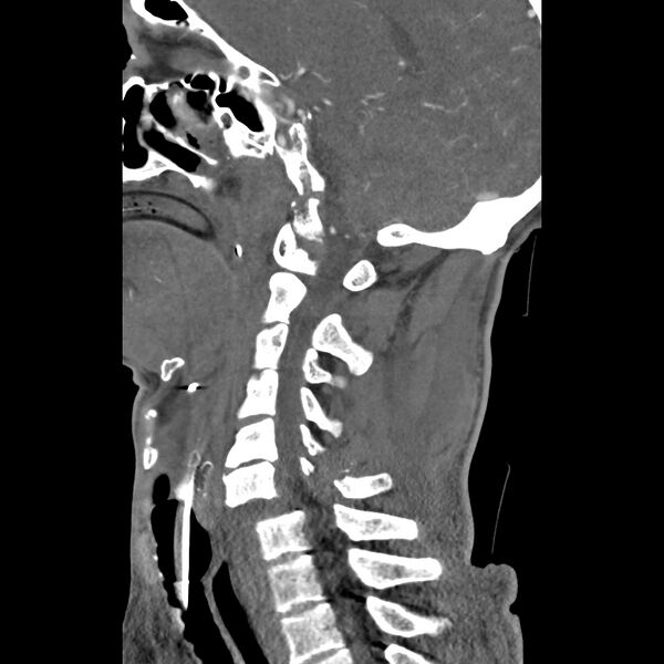 File:Bilateral perched facets with cord injury (Radiopaedia 45587-49713 B 29).jpg