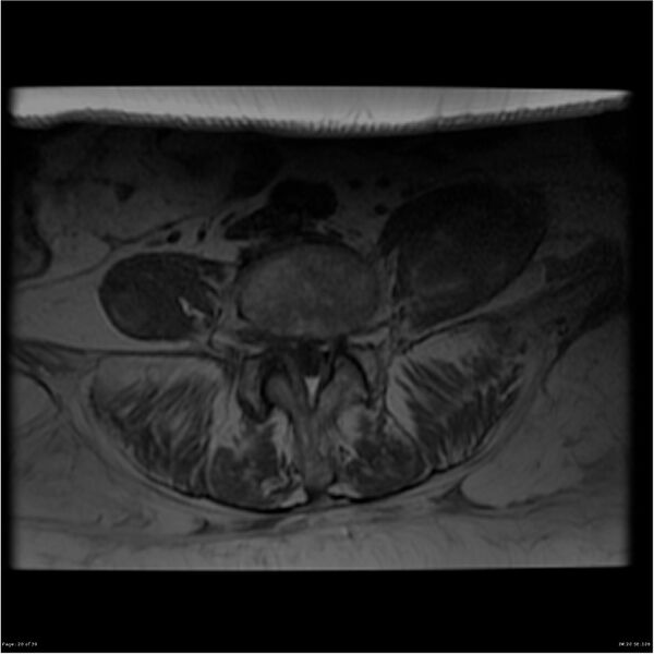 File:Bilateral psoas hematomas (Radiopaedia 24057-24280 T1 20).jpg
