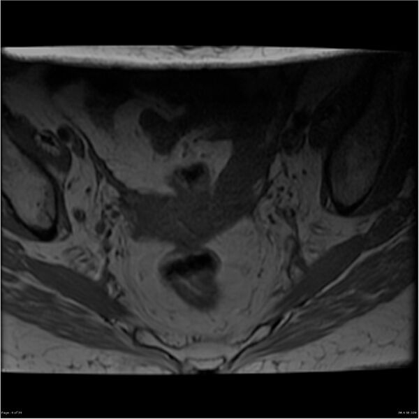 File:Bilateral psoas hematomas (Radiopaedia 24057-24280 T1 4).jpg
