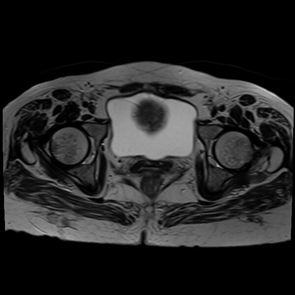 File:Bilateral tubo-ovarian abscesses (Radiopaedia 58635-65829 Axial T2 35).jpg