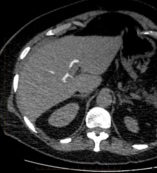 File:Bile leak from accessory duct(s) of Luschka post cholecystectomy (Radiopaedia 40736-43389 A 18).jpg