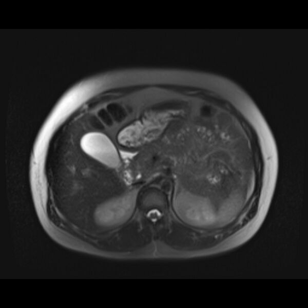 File:Bilobed placenta accreta (Radiopaedia 69648-79591 Axial T2 fat sat 6).jpg