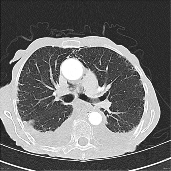 File:Boerhaave syndrome (Radiopaedia 26240-26362 Axial lung window 20).jpg