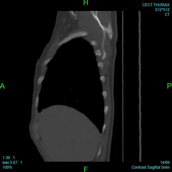 File:Bone metastases from lung carcinoma (Radiopaedia 54703-60937 Sagittal bone window 14).jpg