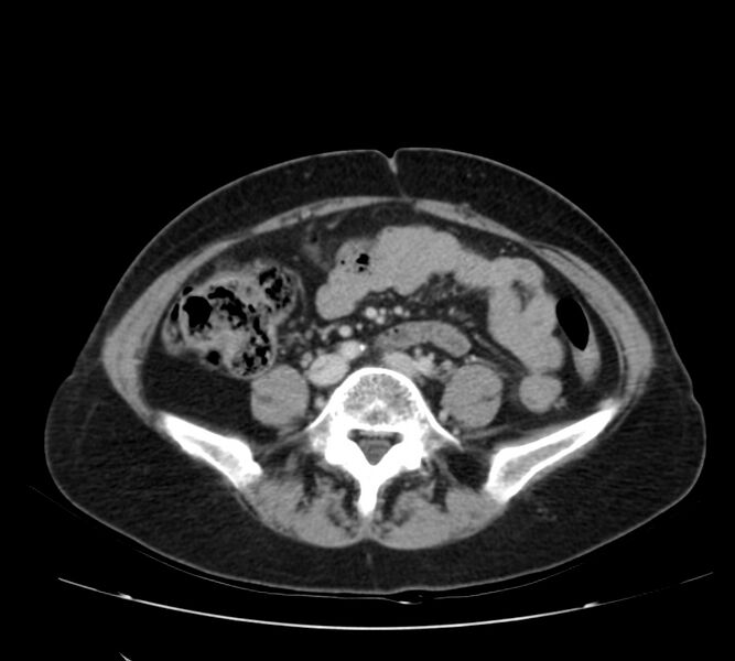 File:Bosniak renal cyst - type IV (Radiopaedia 22929-22953 C 42).jpg
