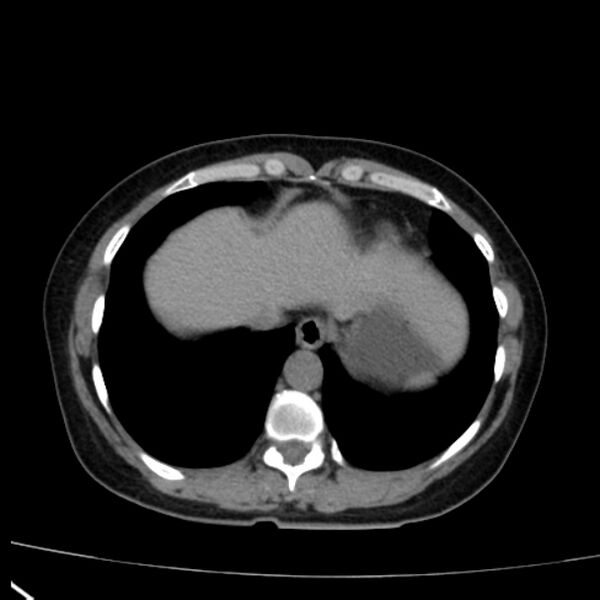 File:Bosniak renal cyst - type I (Radiopaedia 27479-27675 Axial non-contrast 9).jpg