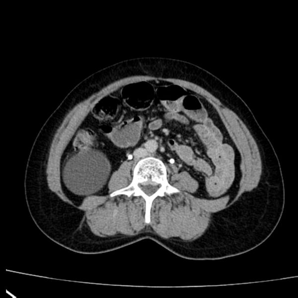 File:Bosniak renal cyst - type I (Radiopaedia 27479-27675 D 32).jpg