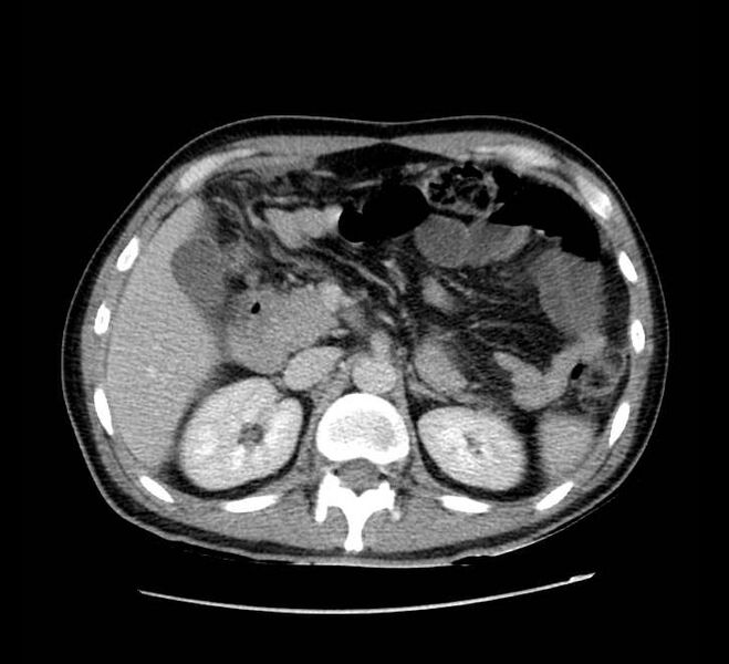 File:Bowel obstruction from colon carcinoma (Radiopaedia 22995-23028 A 26).jpg
