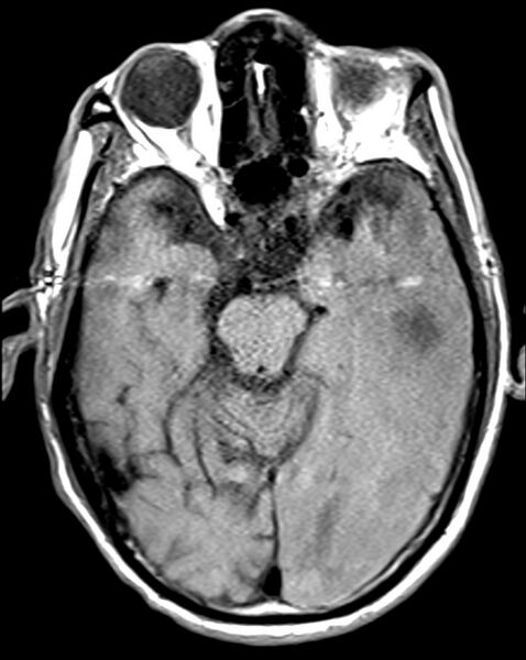 File:Brain abscess with dual rim sign (Radiopaedia 87566-103938 Axial T1 8).jpg