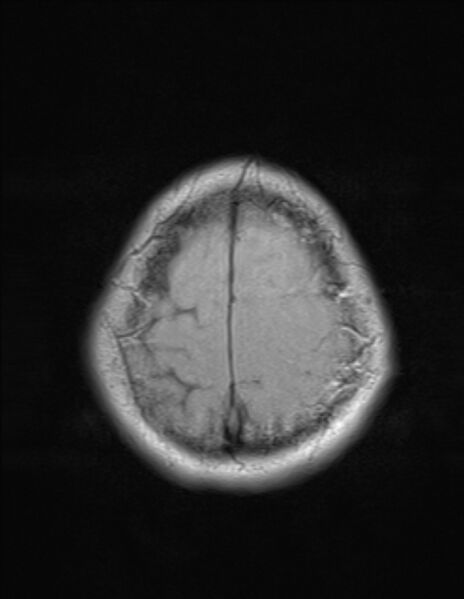 File:Brain abscess with ventriculitis (Radiopaedia 85703-101495 Axial T1 24).jpg