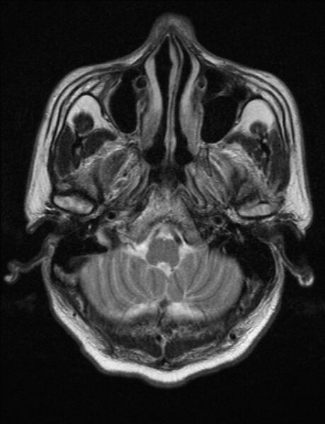 File:Brain abscess with ventriculitis (Radiopaedia 85703-101495 Axial T2 3).jpg