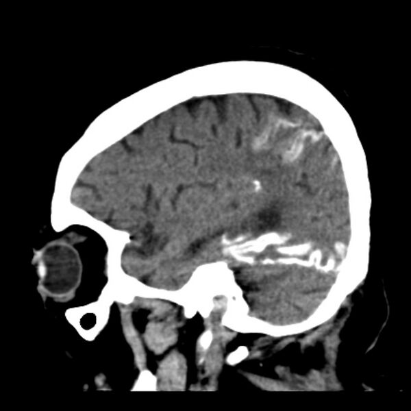 File:Brain cortical laminar necrosis (Radiopaedia 25822-25971 non-contrast 37).jpg