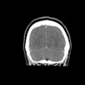 Brain death (Radiopaedia 78597-91360 Coronal non-contrast 64).jpg
