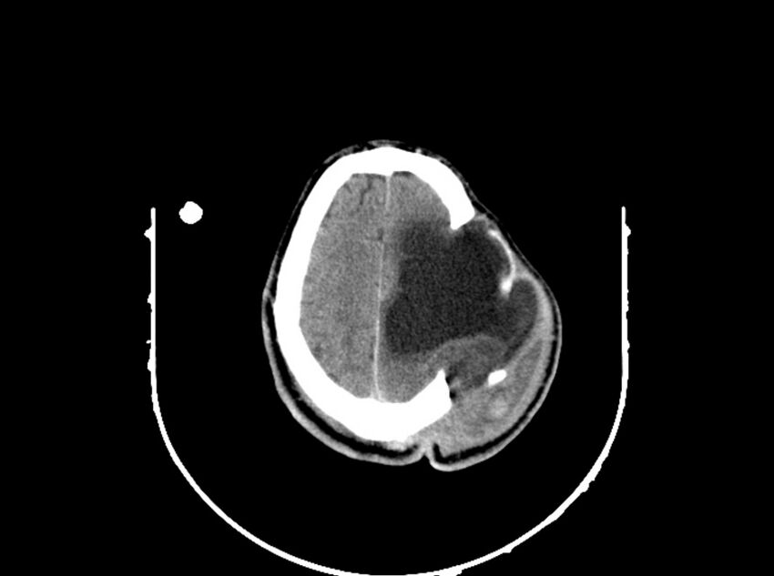 Brain injury by firearm projectile (Radiopaedia 82068-96088 A 173).jpg