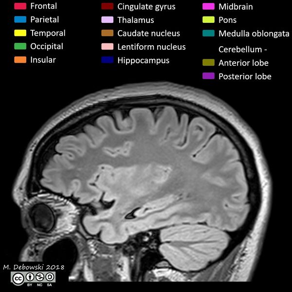 File:Brain lobes - annotated MRI (Radiopaedia 61691-69700 Sagittal 20).JPG