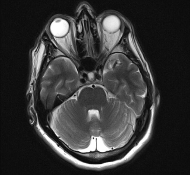 File:Brain metastases - lung cancer primary (Radiopaedia 75060-86115 Axial T2 9).jpg