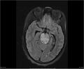 Brainstem glioma (Radiopaedia 21819-21775 Axial FLAIR 16).jpg