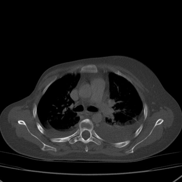 File:Breast cancer metastases - hepatic and skeletal (Radiopaedia 34201-35461 Axial bone window 16).jpg