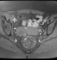 Broad ligament leiomyoma (Radiopaedia 81634-95516 Axial T1 fat sat 14).jpg