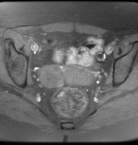 File:Broad ligament leiomyoma (Radiopaedia 81634-95516 Axial T1 fat sat 14).jpg