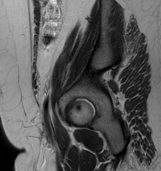 File:Broad ligament leiomyoma (Radiopaedia 81634-95516 Sagittal T2 3).jpg