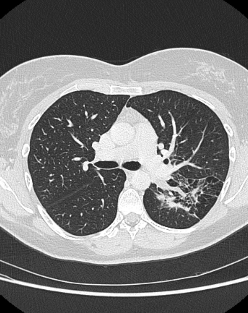 Bronchial atresia (Radiopaedia 50007-55297 Axial lung window 42).jpg