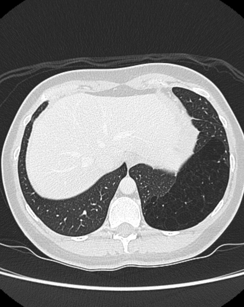 Bronchial atresia (Radiopaedia 50007-55297 Axial lung window 95).jpg
