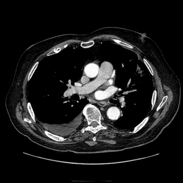 File:Bronchogenic adenocarcinoma and pulmonary embolism (Radiopaedia 9097-9806 D 32).jpg