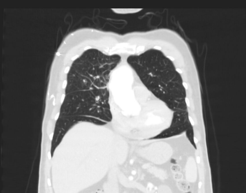 Bronchogenic carcinoma with lymphangitic spread (Radiopaedia 29002-29357 Coronal lung window 21).jpg