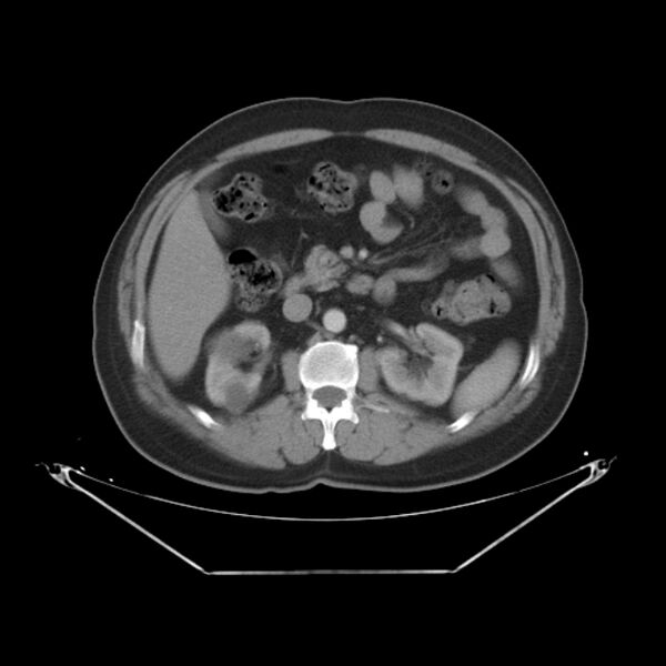File:Bronchogenic carcinoma with upper lobe collapse (Radiopaedia 29297-29726 C 37).jpg
