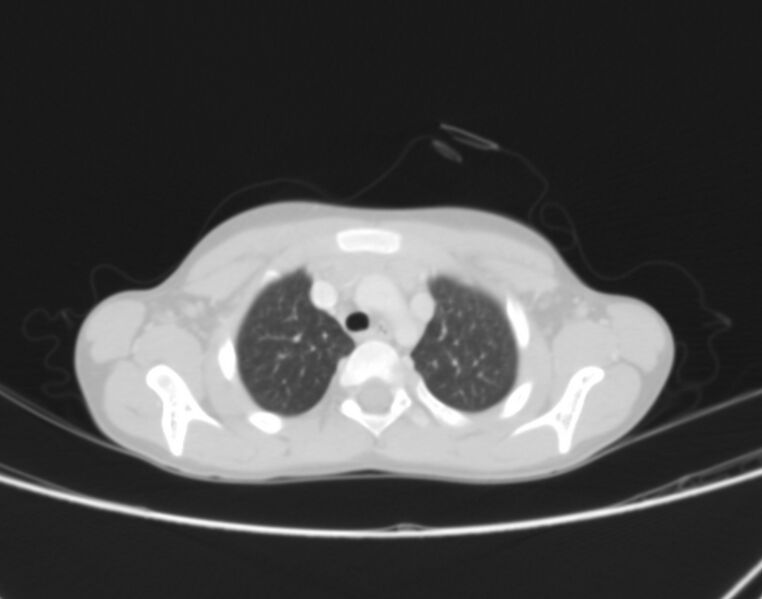 File:Bronchus suis (Radiopaedia 68131-77620 Axial lung window 1).jpg