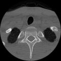 C5 facet fracture (Radiopaedia 58374-65499 Axial bone window 89).jpg