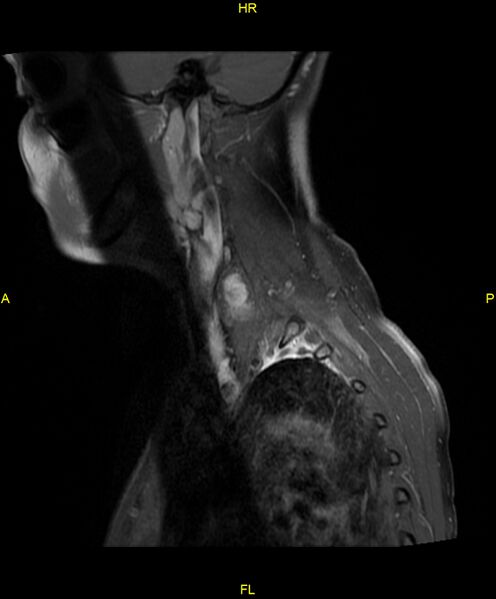 File:C5 nerve sheath tumor (Radiopaedia 85777-101596 F 18).jpg