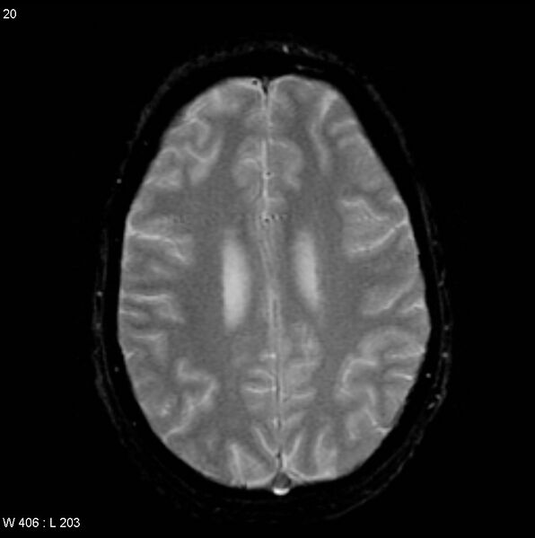File:CMV ventriculitis and encephalitis (Radiopaedia 5416-7166 Axial Gradient Echo 5).jpg