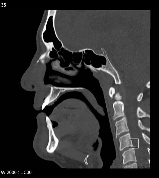 File:Calcification of the transverse band of the cruciform ligament (Radiopaedia 53063-59025 Sagittal bone window 12).jpg