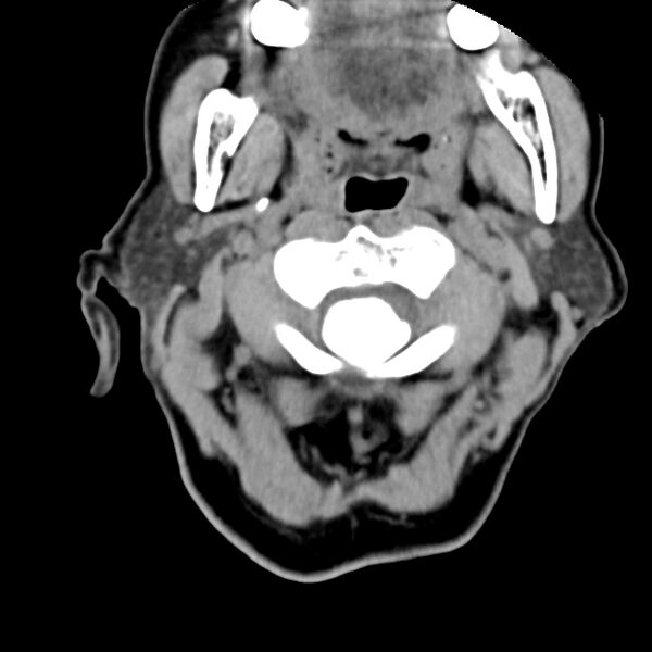 File:Calcified meningioma - cervical canal (Radiopaedia 70136-80171 B 7).jpg