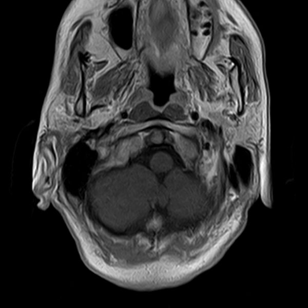 File:Calcified meningioma - cervical canal (Radiopaedia 70136-82468 Axial T1 C+ 5).jpg