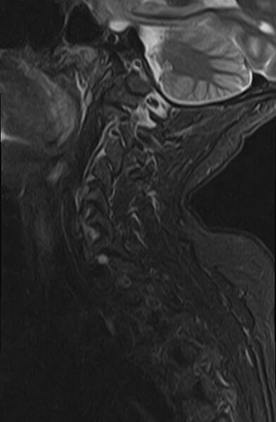 File:Calcified meningioma - cervical canal (Radiopaedia 70136-82468 Sagittal STIR 11).jpg