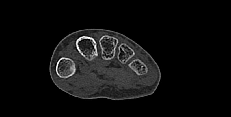 File:Calcifying aponeurotic fibroma (Radiopaedia 88423-105064 Axial bone window 129).jpg