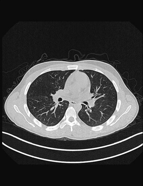 File:Calcifying pulmonary metastases (Radiopaedia 33359-34396 Axial lung window 30).jpg