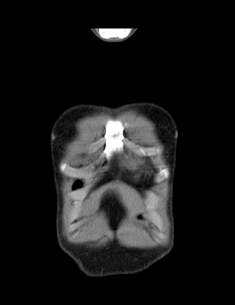 File:Calcifying pulmonary metastases (Radiopaedia 33359-34396 Coronal non-contrast 46).jpg