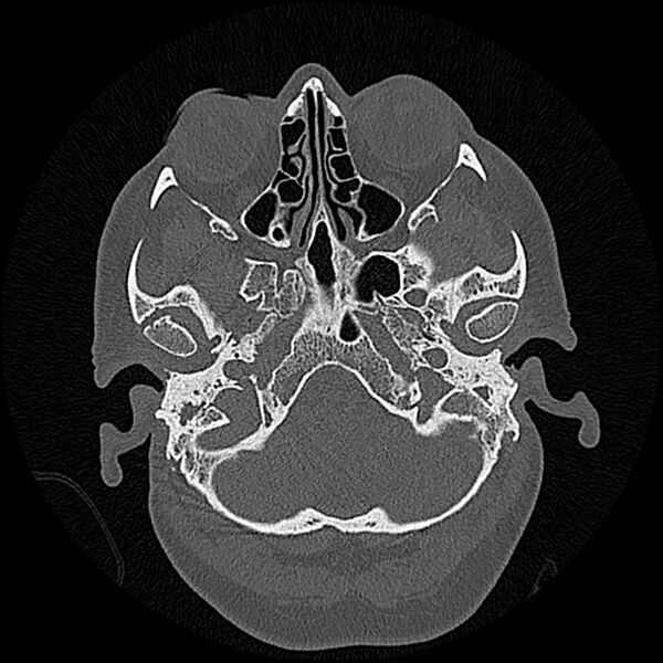 File:Canal up mastoidectomy (Radiopaedia 78108-90638 Axial bone window 36).jpg