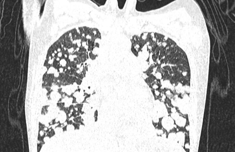 File:Cannonball metastases from breast cancer (Radiopaedia 91024-108569 Coronal lung window 62).jpg